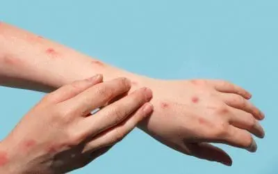 Affenpocken-Ausbruch